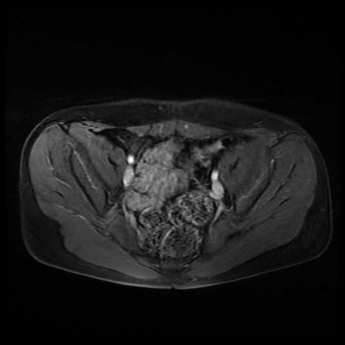 Ambiguous genitalia (Radiopaedia 69686-79643 Axial T1 C+ fat sat 19).jpg
