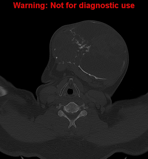 Ameloblastoma (Radiopaedia 33126-34164 Axial bone window 28).jpg