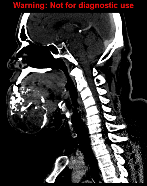 Ameloblastoma (Radiopaedia 33126-34164 F 37).jpg