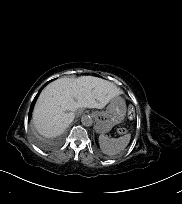 Amiodarone deposition in the liver (Radiopaedia 77587-89780 Axial non-contrast 73).jpg