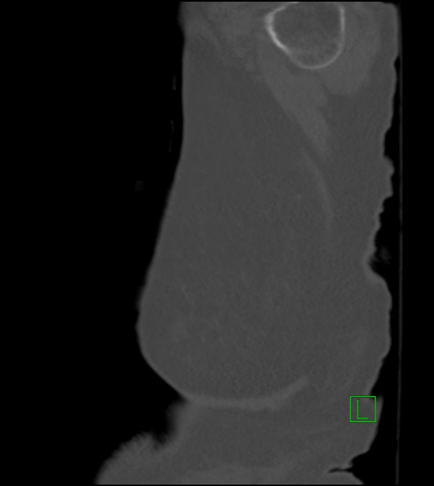 Amiodarone deposition in the liver (Radiopaedia 77587-89780 Sagittal bone window 5).jpg