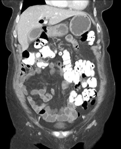 Ampullary adenocarcinoma (Radiopaedia 34013-35237 E 18).png