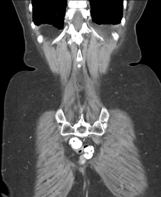 Ampullary adenocarcinoma (Radiopaedia 34013-35237 E 44).png