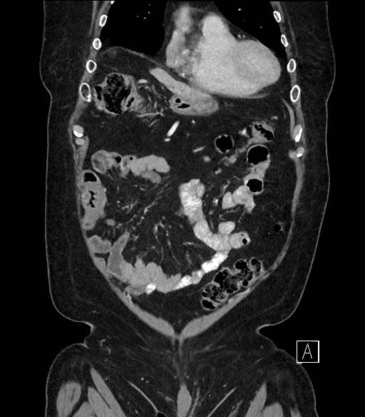 Ampullary adenocarcinoma (Radiopaedia 59373-66734 D 18).jpg