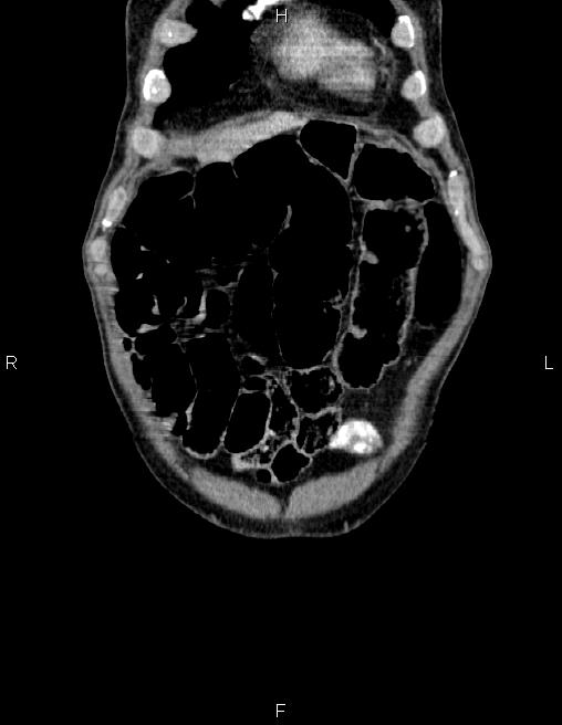 Ampullary adenocarcinoma (Radiopaedia 86093-102032 C 5).jpg