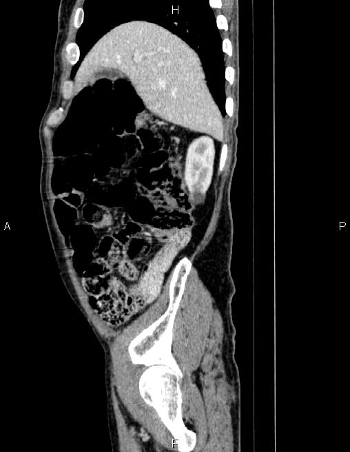 Ampullary adenocarcinoma (Radiopaedia 86093-102032 D 18).jpg
