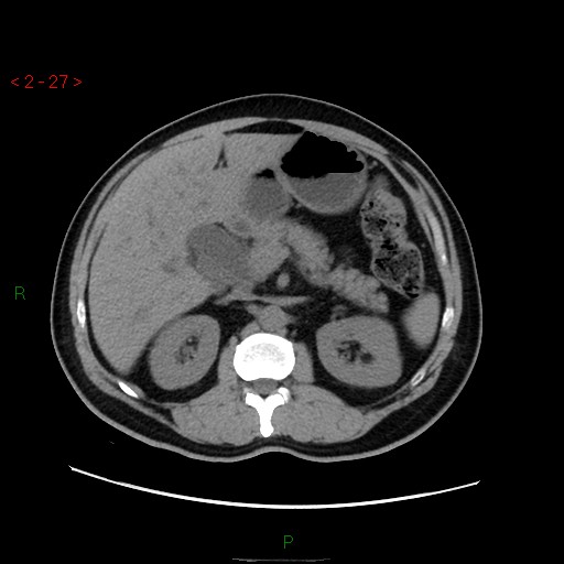 File:Ampullary carcinoma (Radiopaedia 56396-63056 Axial non-contrast 18).jpg