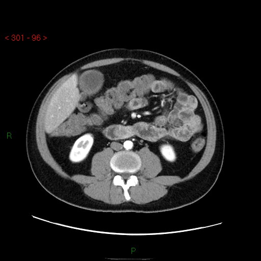 File:Ampullary carcinoma (Radiopaedia 56396-63056 B 42).jpg