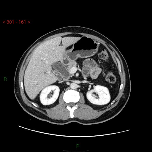 File:Ampullary carcinoma (Radiopaedia 56396-63056 C 35).jpg