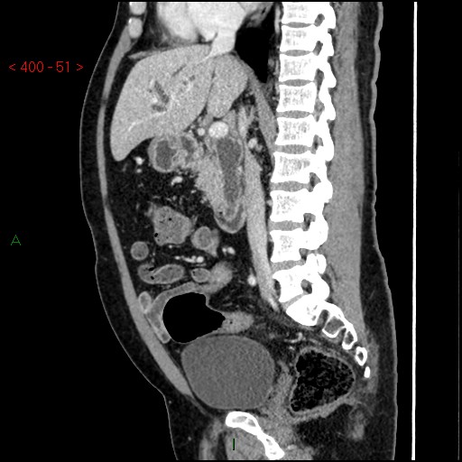 Ampullary carcinoma (Radiopaedia 56396-63056 D 50).jpg