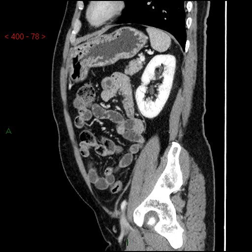 Ampullary carcinoma (Radiopaedia 56396-63056 D 77).jpg