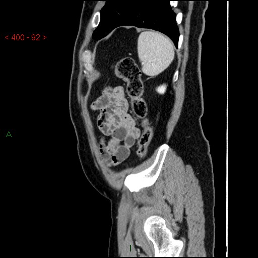 Ampullary carcinoma (Radiopaedia 56396-63056 D 91).jpg