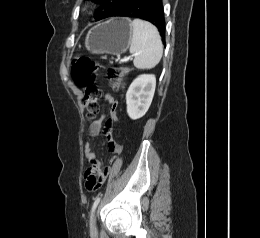 File:Ampullary tumor (Radiopaedia 60333-67998 C 49).jpg