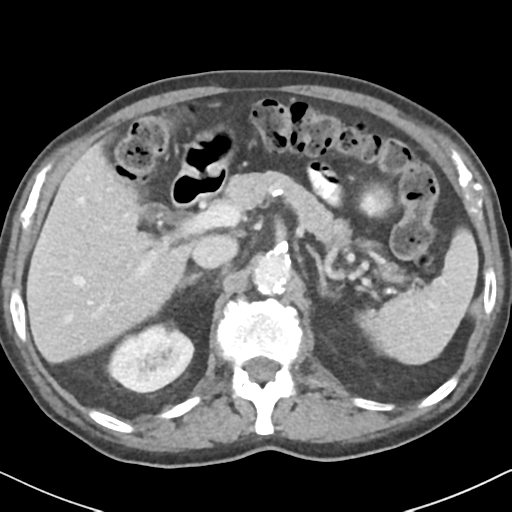 File:Amyand hernia (Radiopaedia 39300-41547 A 18).png