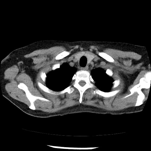 Amyloidosis - bronchial and diffuse nodular pulmonary involvement (Radiopaedia 60156-67744 Axial non-contrast 7).jpg