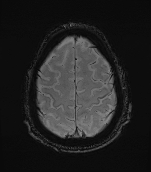 Amyotrophic lateral sclerosis (Radiopaedia 87352-103658 Axial SWI 54).jpg