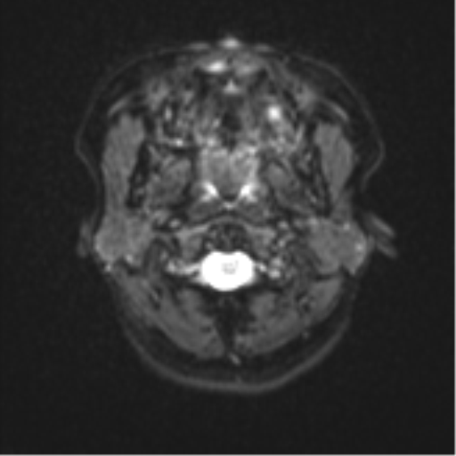 Anaplastic astroblastoma (Radiopaedia 55666-62194 Axial DWI 1).png