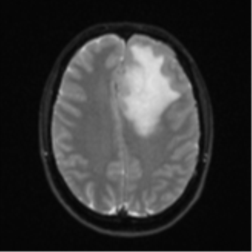 File:Anaplastic astrocytoma (Radiopaedia 57768-64731 Axial DWI 19).png
