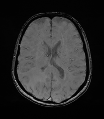 Anaplastic astrocytoma (Radiopaedia 86943-103160 Axial SWI 54).png