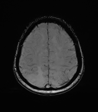 File:Anaplastic astrocytoma (Radiopaedia 86943-103160 Axial SWI 69).png