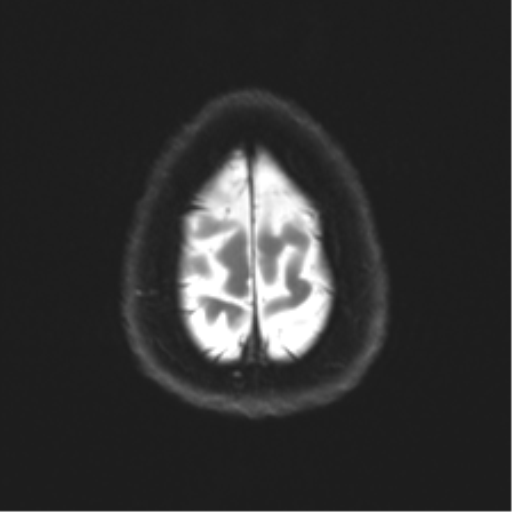 File:Anaplastic astrocytoma - thalamic glioma (Radiopaedia 59709-67115 Axial DWI 32).png