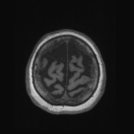 File:Anaplastic astrocytoma IDH wild-type (pseudoprogression) (Radiopaedia 42209-45276 Axial T1 131).png
