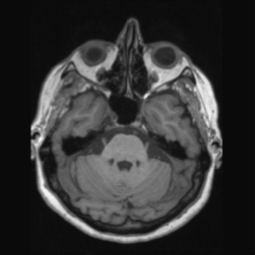 Anaplastic astrocytoma IDH wild-type (pseudoprogression) (Radiopaedia 42209-45276 Axial T1 50).png