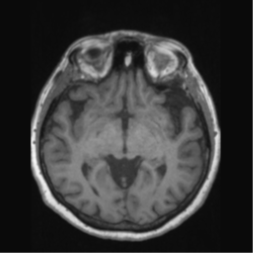 Anaplastic astrocytoma IDH wild-type (pseudoprogression) (Radiopaedia 42209-45276 Axial T1 71).png