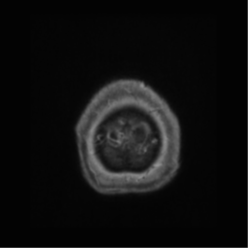 Anaplastic astrocytoma IDH wild-type (pseudoprogression) (Radiopaedia 42209-45277 Axial T1 C+ 129).png