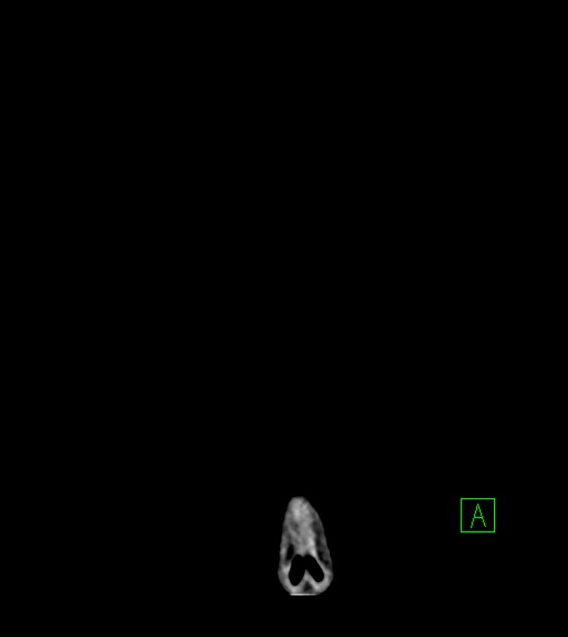 Anaplastic oligodendroglioma (Radiopaedia 79571-92753 Coronal non-contrast 3).jpg