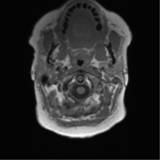File:Anaplastic oligodendroglioma (Radiopaedia 83500-98599 Axial T1 4).png