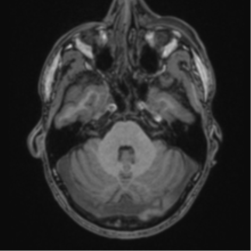 Anaplastic oligodendroglioma with skull fracture (Radiopaedia 74831-85845 Axial T1 13).png