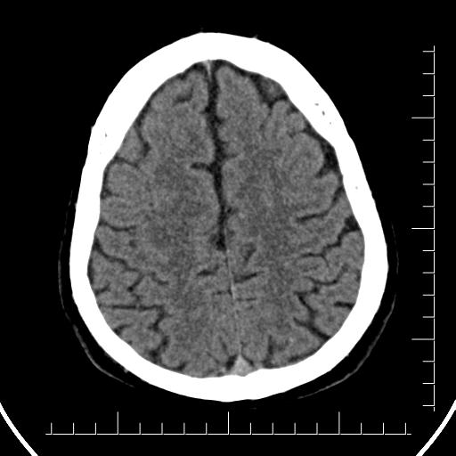 File:Aneurysm of posterior communicating artery (Radiopaedia 20188-20162 Axial non-contrast 37).jpg