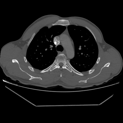 File:Aneurysmal bone cyst - rib (Radiopaedia 82167-96220 Axial bone window 101).jpg