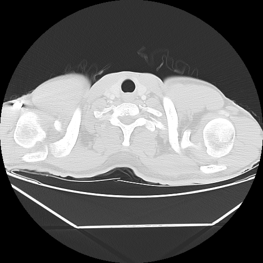 File:Aneurysmal bone cyst - rib (Radiopaedia 82167-96220 Axial lung window 7).jpg