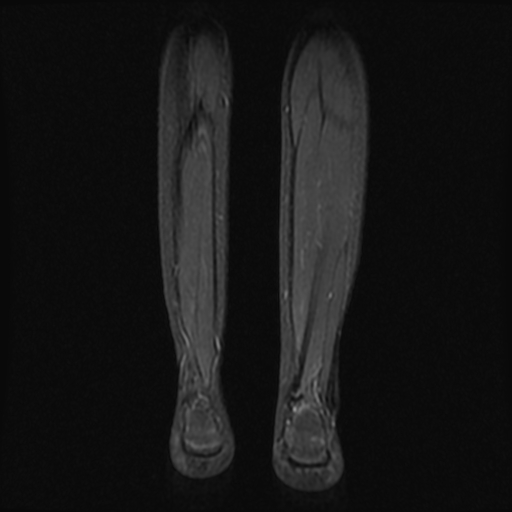 File:Aneurysmal bone cyst - tibia (Radiopaedia 22343-22367 Coronal STIR 16).jpg