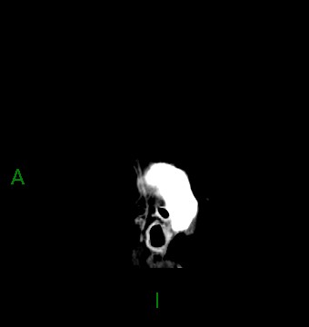 File:Aneurysmal subarachnoid hemorrhage with intra-axial extension (Radiopaedia 84371-99699 B 2).jpg