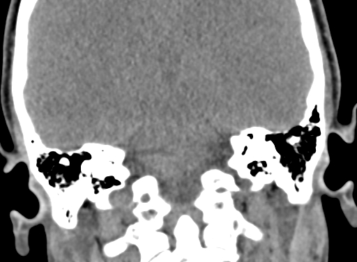 Angular dermoid cyst (Radiopaedia 88967-105790 Coronal non-contrast 80).jpg
