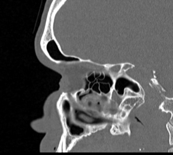 Angular epidermoid cyst (Radiopaedia 46908-51439 Sagittal bone window 29).png