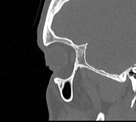 Angular epidermoid cyst (Radiopaedia 46908-51439 Sagittal bone window 6).png