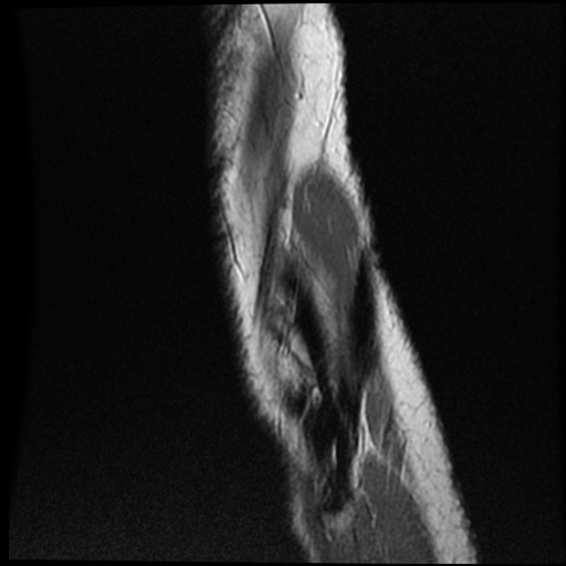 Anomalous insertion of the medial meniscus (Radiopaedia 77559-89721 Sagittal PD 7).jpg