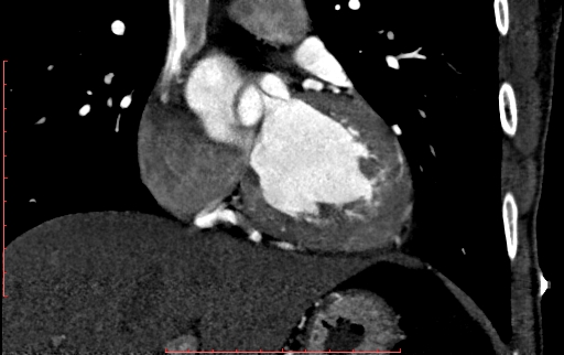 Anomalous left coronary artery from the pulmonary artery (ALCAPA) (Radiopaedia 70148-80181 B 151).jpg