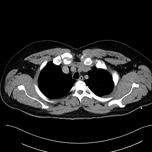 File:Anomalous origin of the left coronary artery with malignant course (Radiopaedia 77842-90126 Axial non-contrast 8).jpeg