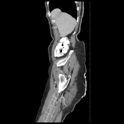 Anorectal carcinoma (Radiopaedia 44413-48064 C 6).jpg