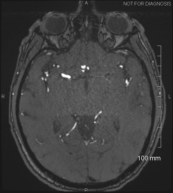 Anterior cerebral artery aneurysm (Radiopaedia 80683-94127 Axial MRA 110).jpg