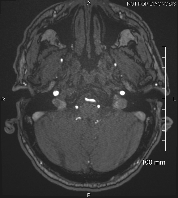 Anterior cerebral artery aneurysm (Radiopaedia 80683-94127 Axial MRA 34).jpg
