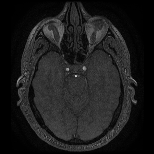 Anterior cerebral artery infarction (Radiopaedia 46794-51323 Axial MRA 56).jpg