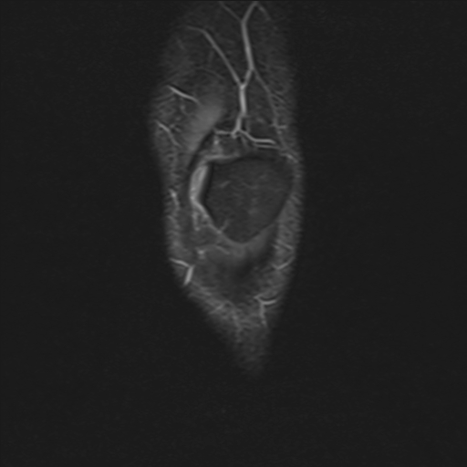 File:Anterior cruciate ligament full thickness tear (Radiopaedia 66268-75467 Coronal STIR 2).jpg