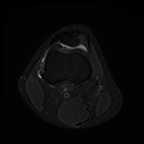 File:Anterior cruciate ligament graft tear and bucket-handle tear of medial meniscus (Radiopaedia 75867-87254 Axial PD fat sat 23).jpg