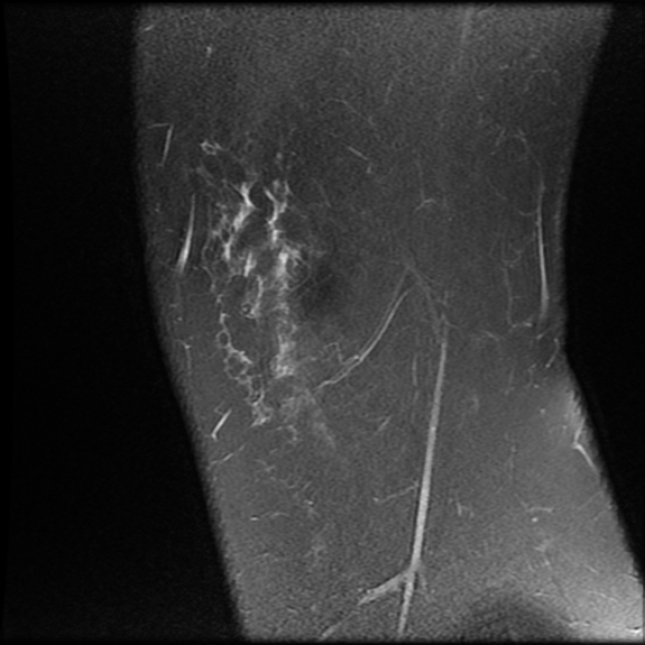 File:Anterior cruciate ligament tear, Wrisberg rip and bucket-handle tear of medial meniscus (Radiopaedia 75872-87266 Sagittal PD fat sat 26).jpg